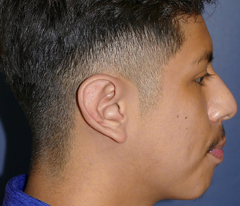 Ear Pinning (Otoplasty) Before & After Gallery - Patient 369466 - Image 8