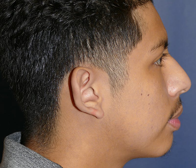 Ear Pinning (Otoplasty) Before & After Gallery - Patient 369466 - Image 7