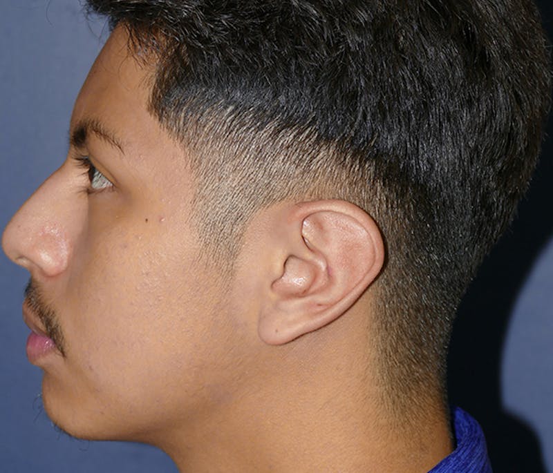 Ear Pinning (Otoplasty) Before & After Gallery - Patient 369466 - Image 6