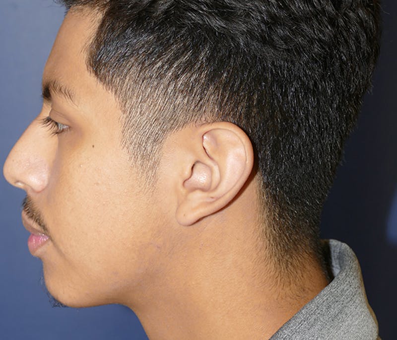 Ear Pinning (Otoplasty) Before & After Gallery - Patient 369466 - Image 5