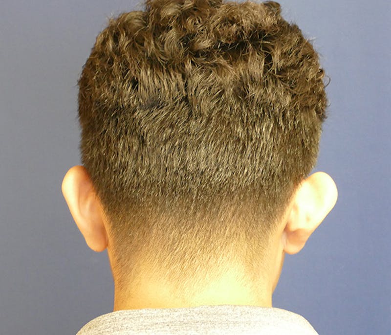 Ear Pinning (Otoplasty) Before & After Gallery - Patient 369466 - Image 3