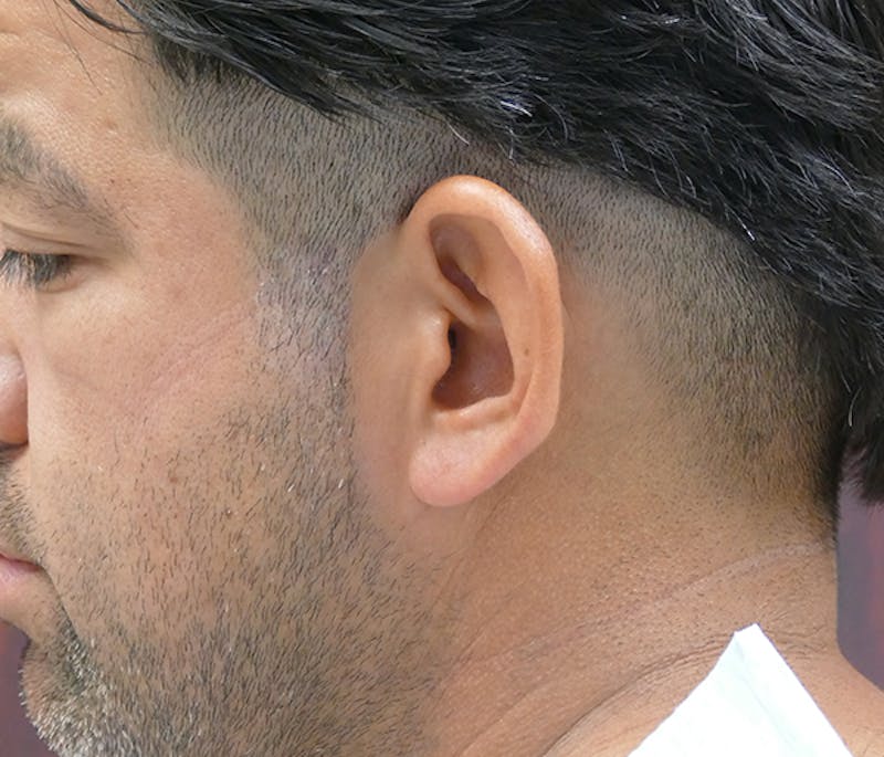 Ear Pinning (Otoplasty) Before & After Gallery - Patient 849865 - Image 7
