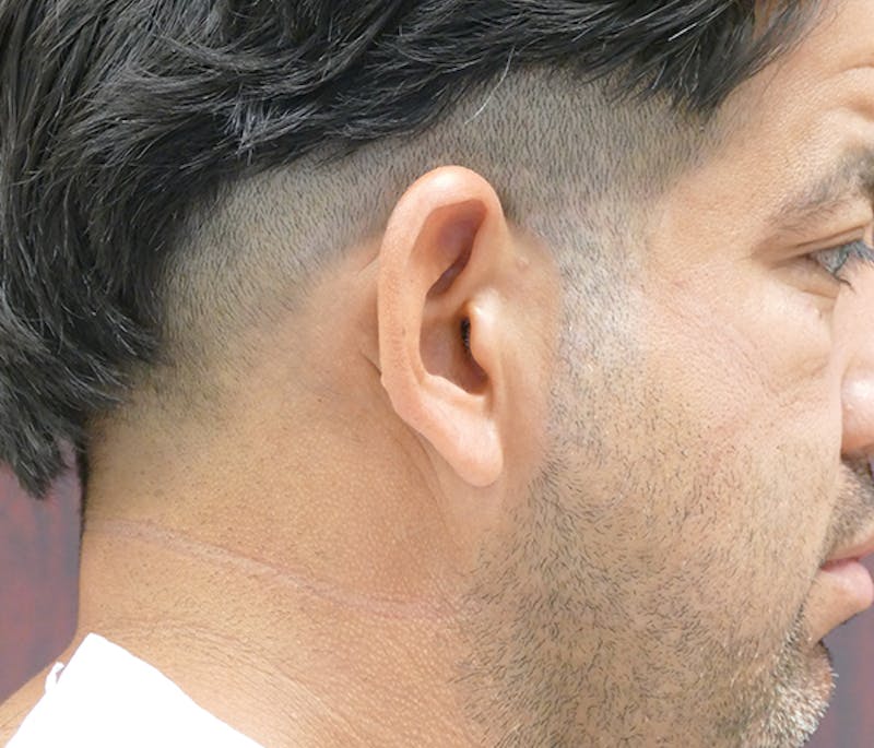 Ear Pinning (Otoplasty) Before & After Gallery - Patient 849865 - Image 5