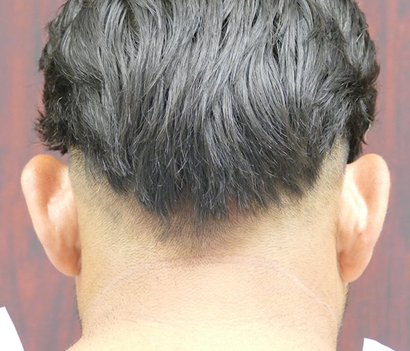 Ear Pinning (Otoplasty) Before & After Gallery - Patient 849865 - Image 3
