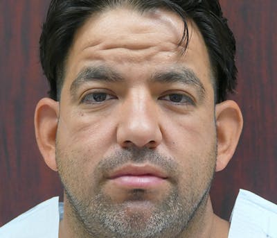 Ear Pinning (Otoplasty) Before & After Gallery - Patient 849865 - Image 1