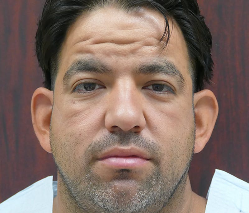 Ear Pinning (Otoplasty) Before & After Gallery - Patient 849865 - Image 1