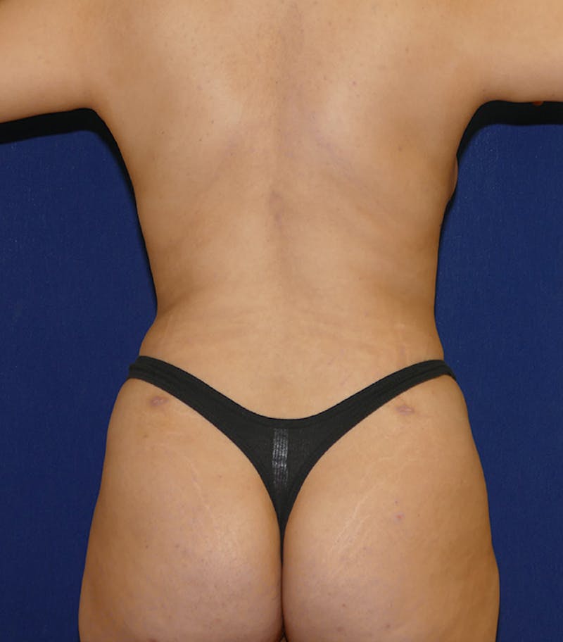 Liposuction Before & After Gallery - Patient 264163 - Image 8