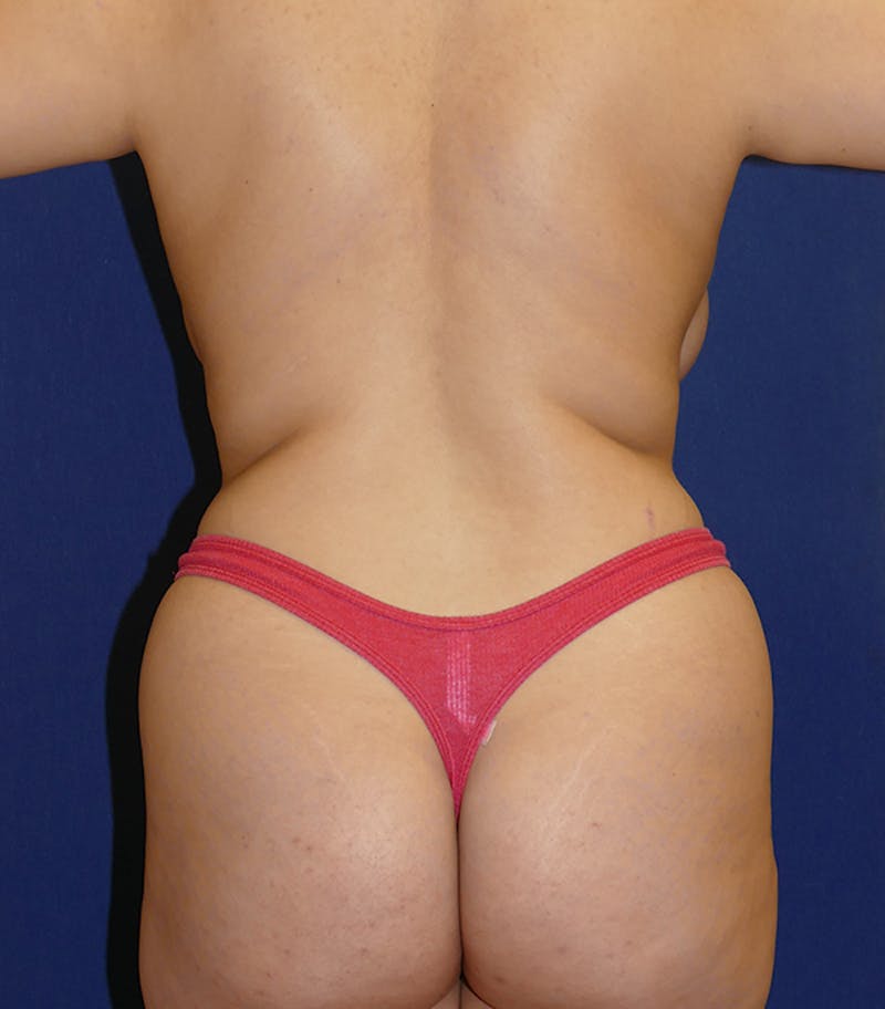Liposuction Before & After Gallery - Patient 264163 - Image 7