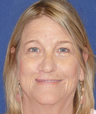 Miscellaneous Before & After Gallery - Patient 190726 - Image 2