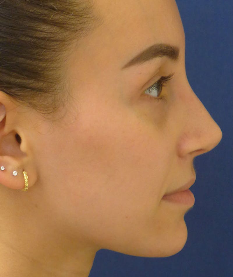 Rhinoplasty Before & After Gallery - Patient 137010 - Image 6