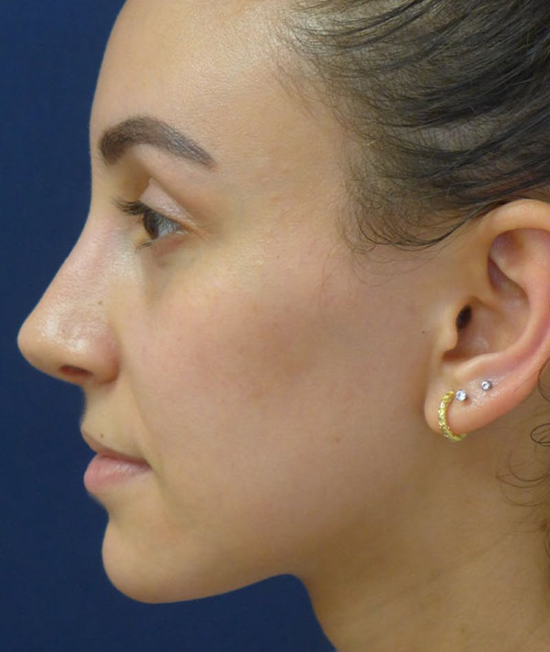 Rhinoplasty Before & After Gallery - Patient 137010 - Image 4