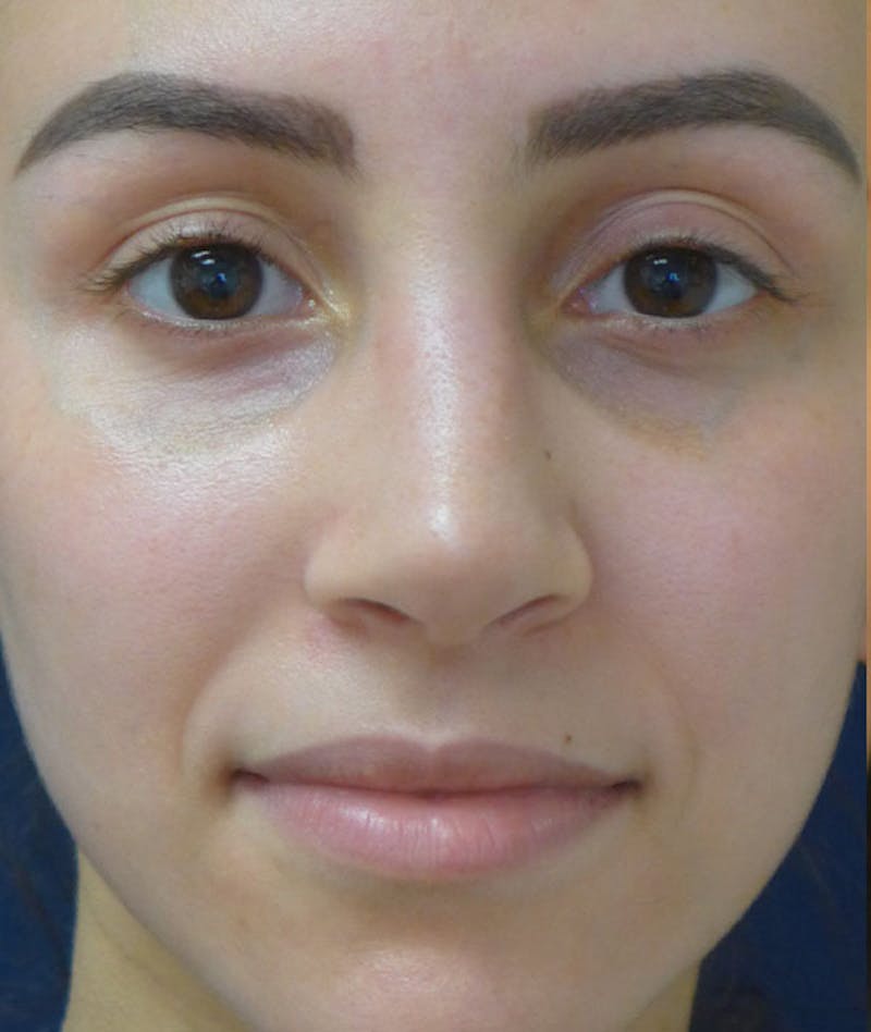 Rhinoplasty Before & After Gallery - Patient 137010 - Image 2