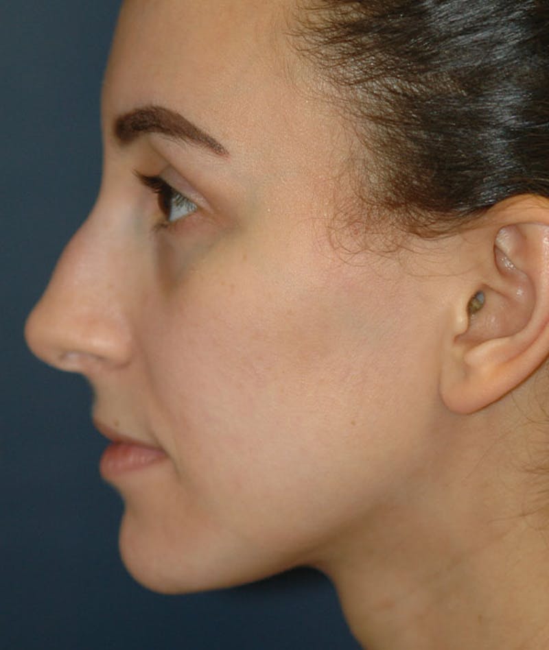 Rhinoplasty Before & After Gallery - Patient 137010 - Image 3