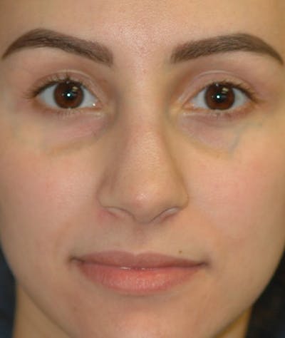 Rhinoplasty Before & After Gallery - Patient 137010 - Image 1
