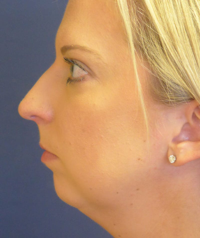 Rhinoplasty Before & After Gallery - Patient 249797 - Image 1