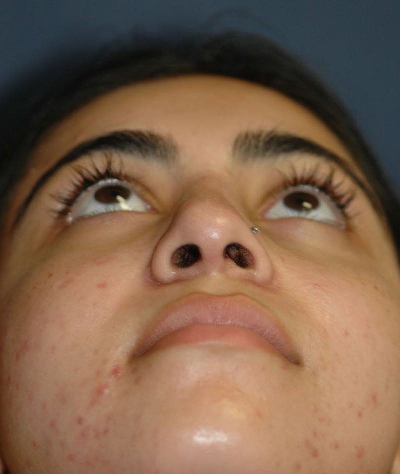 Rhinoplasty Before & After Gallery - Patient 357934 - Image 4