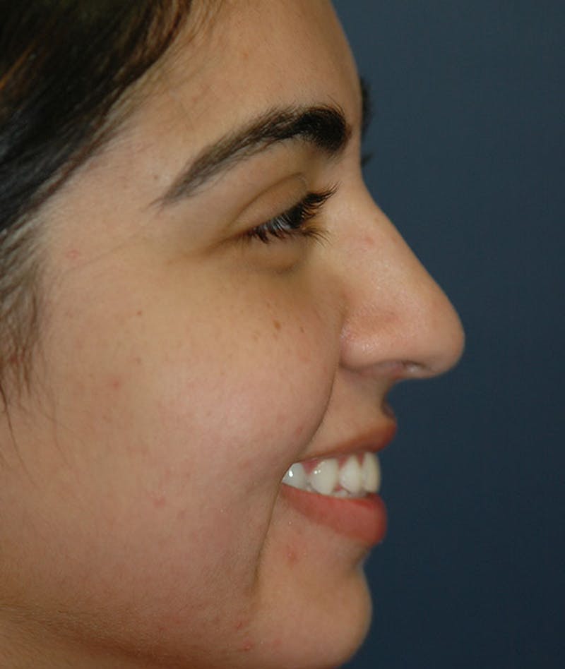 Rhinoplasty Before & After Gallery - Patient 357934 - Image 5