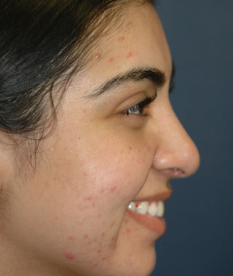 Rhinoplasty Before & After Gallery - Patient 357934 - Image 6