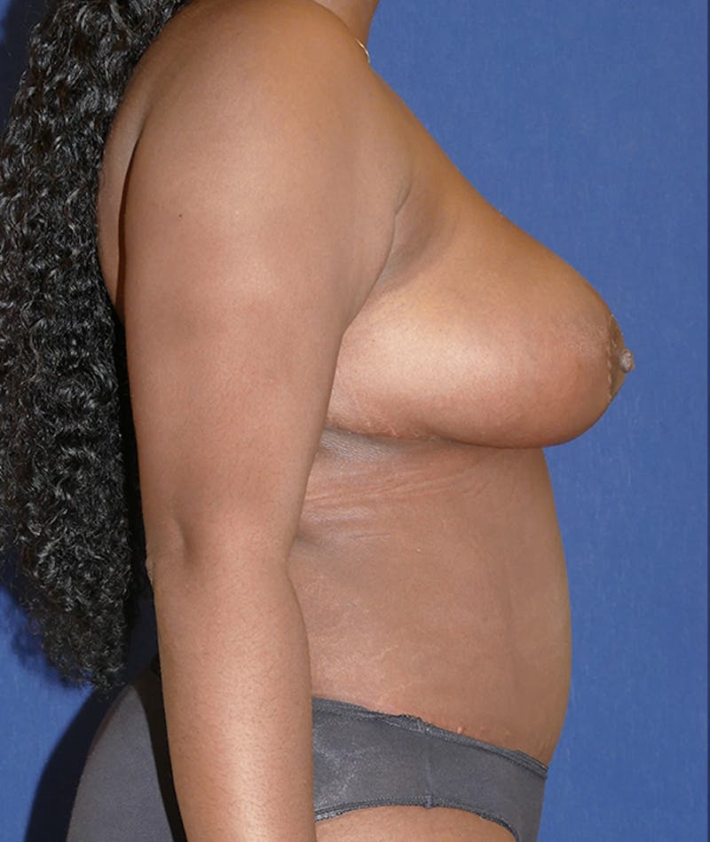 Breast Reduction Before & After Gallery - Patient 261517 - Image 10