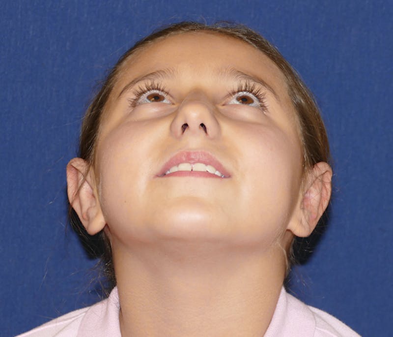 Otoplasty Before & After Gallery - Patient 378363 - Image 4