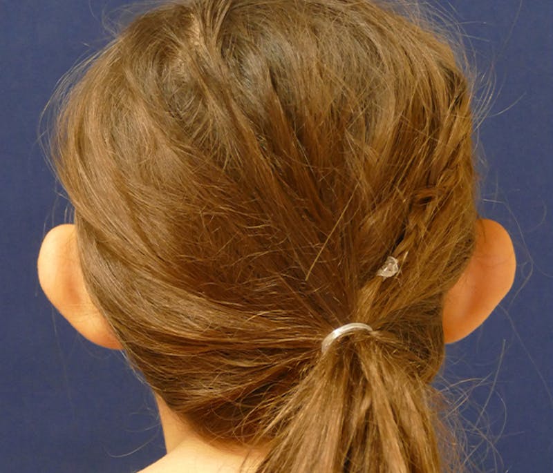 Otoplasty Before & After Gallery - Patient 378363 - Image 5