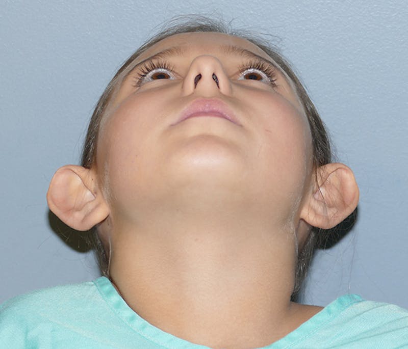 Otoplasty Before & After Gallery - Patient 378363 - Image 3