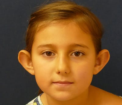 Otoplasty Before & After Gallery - Patient 378363 - Image 1