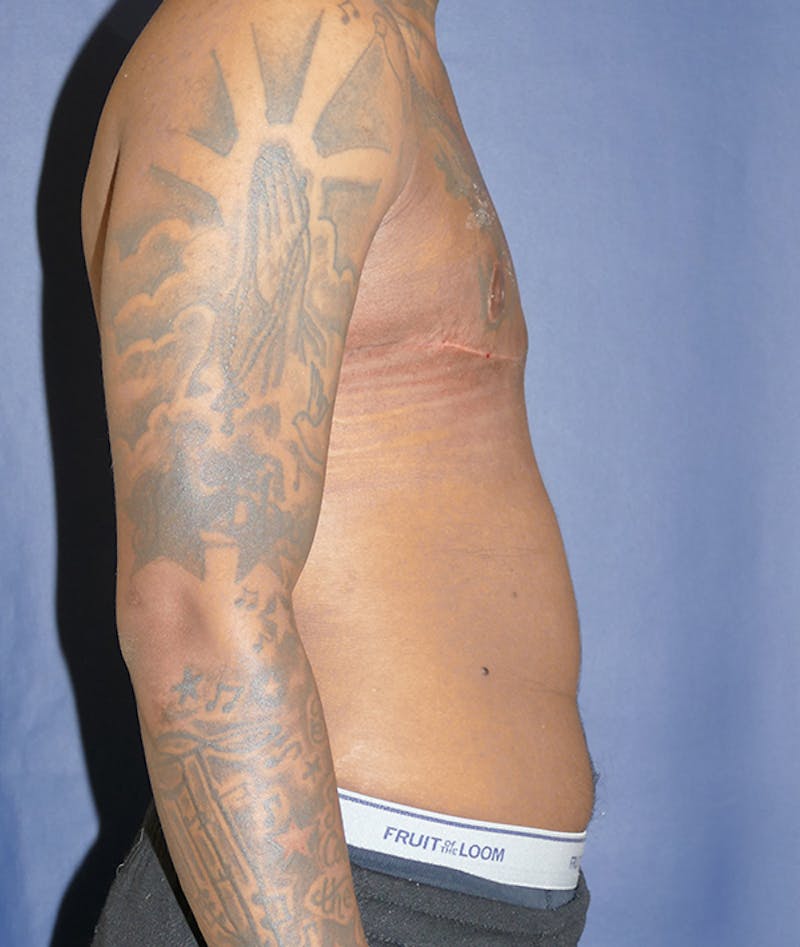 Masculinizing Surgery Before & After Gallery - Patient 386882 - Image 10