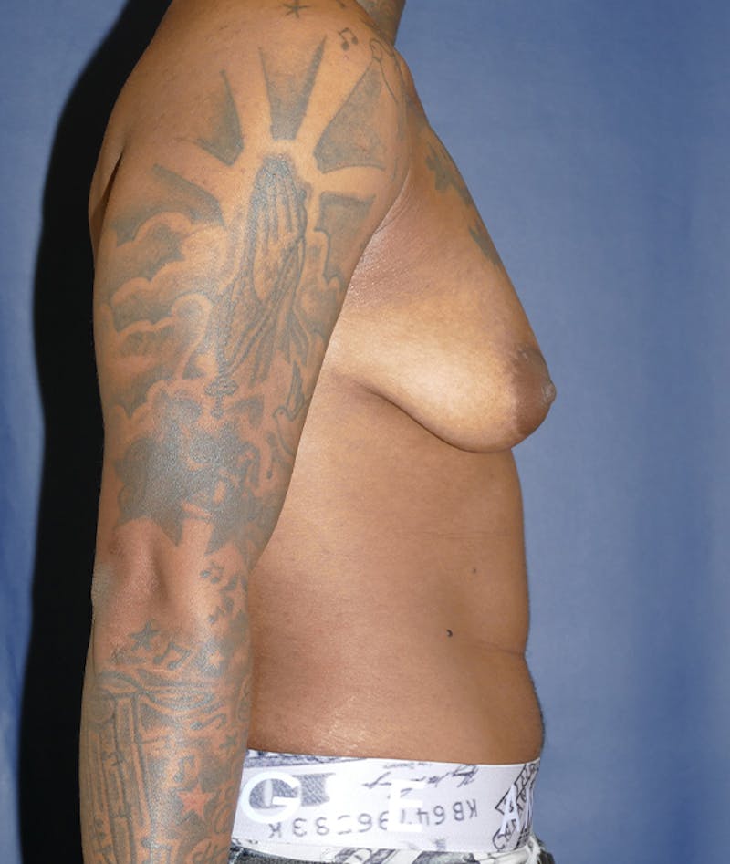 Masculinizing Surgery Before & After Gallery - Patient 386882 - Image 9