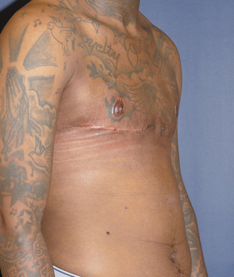 Masculinizing Surgery Before & After Gallery - Patient 386882 - Image 8