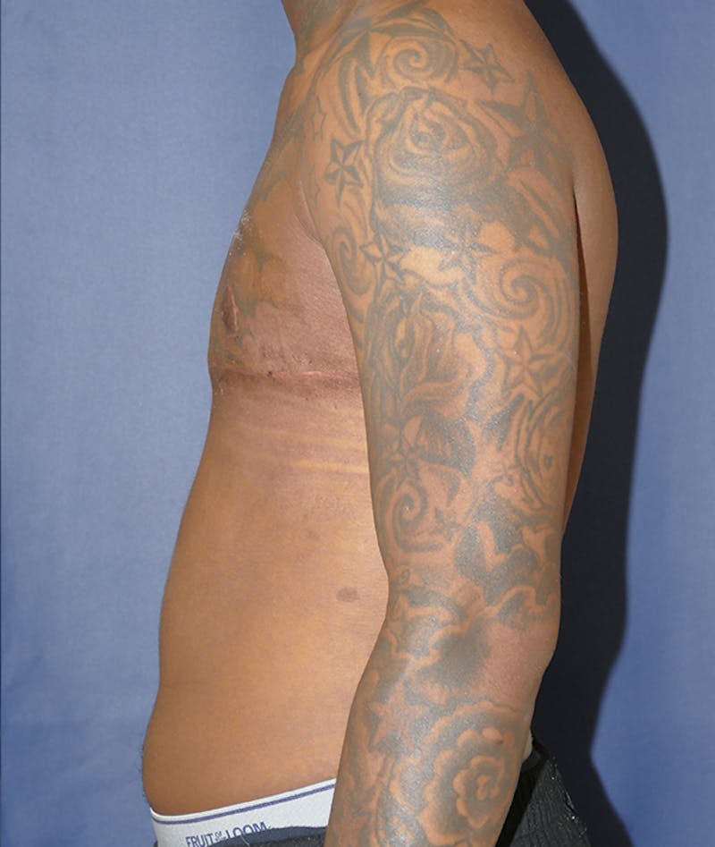 Masculinizing Surgery Before & After Gallery - Patient 386882 - Image 6