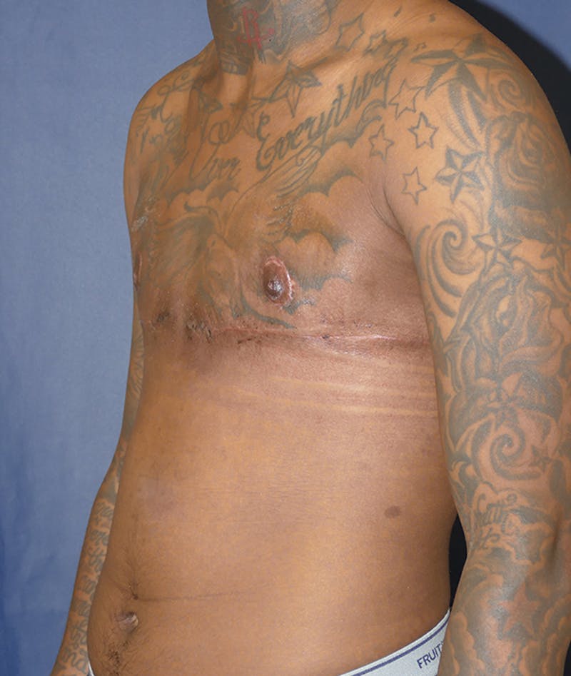 Masculinizing Surgery Before & After Gallery - Patient 386882 - Image 4