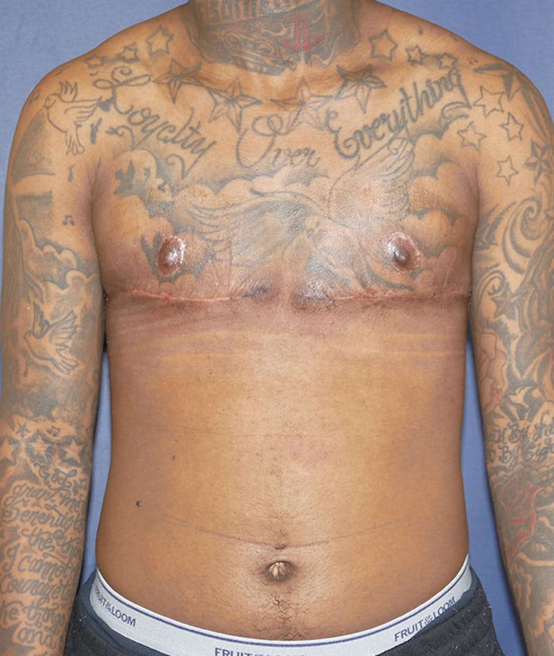 Masculinizing Surgery Before & After Gallery - Patient 386882 - Image 2
