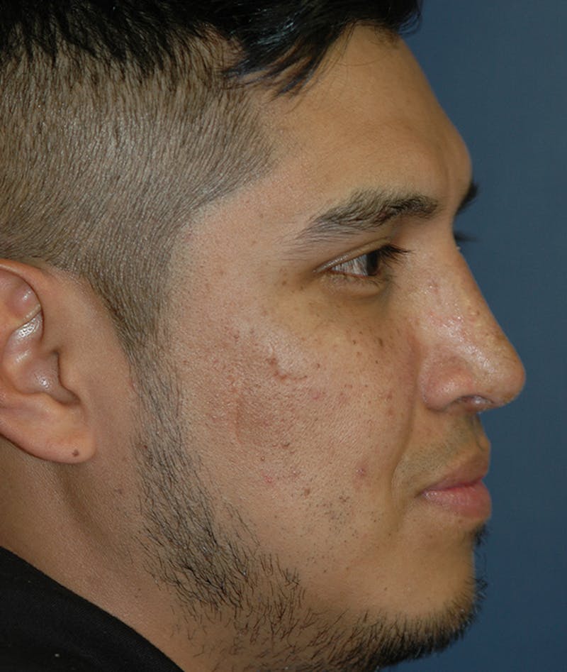 Rhinoplasty Before & After Gallery - Patient 400236 - Image 6