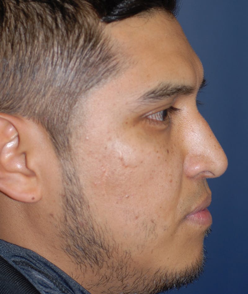 Rhinoplasty Before & After Gallery - Patient 400236 - Image 5