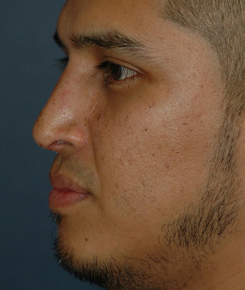 Rhinoplasty Before & After Gallery - Patient 400236 - Image 4