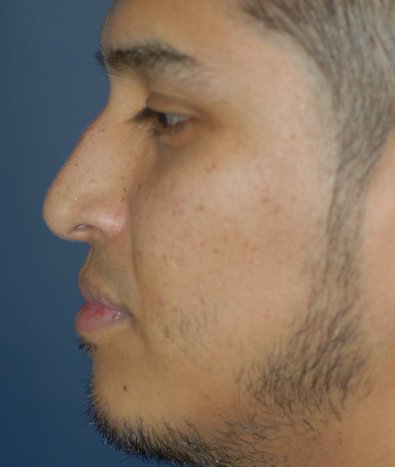 Rhinoplasty Before & After Gallery - Patient 400236 - Image 3