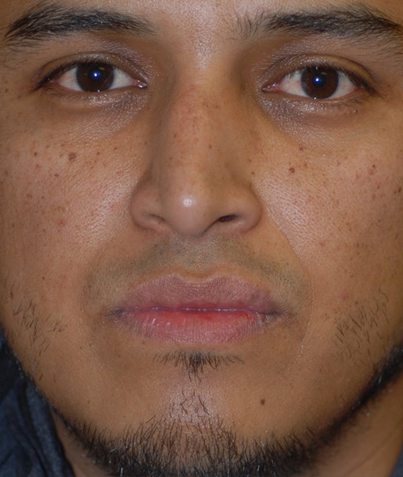 Rhinoplasty Before & After Gallery - Patient 400236 - Image 1