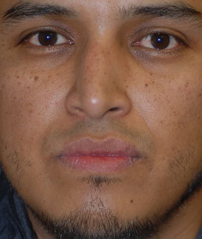 Rhinoplasty Before & After Gallery - Patient 400236 - Image 1