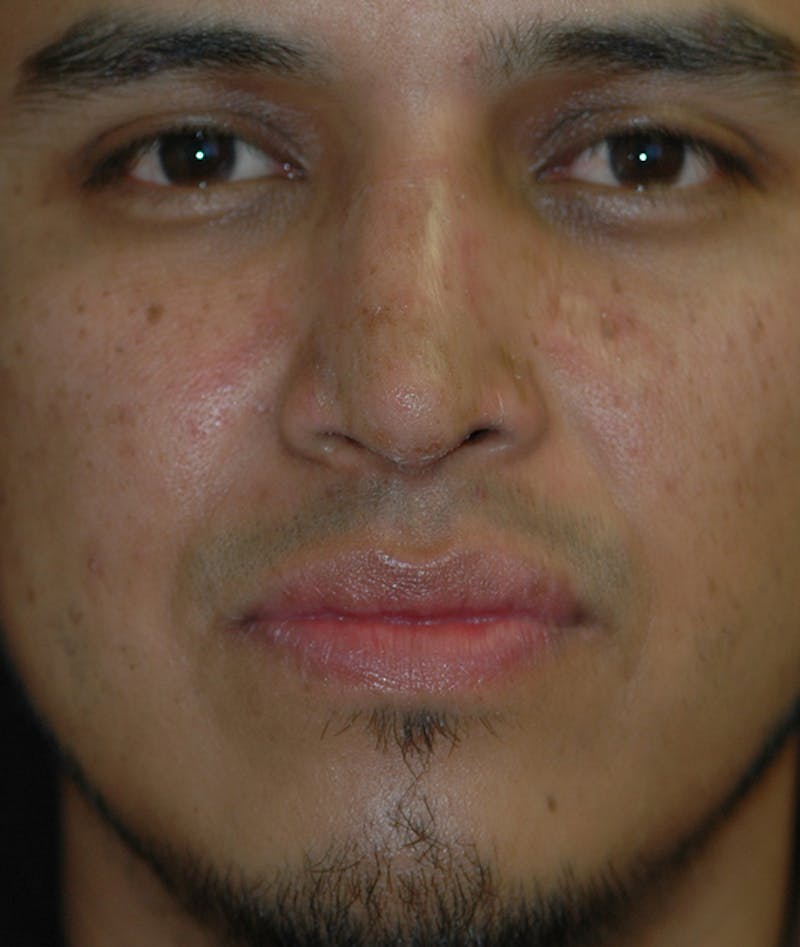 Rhinoplasty Before & After Gallery - Patient 400236 - Image 2