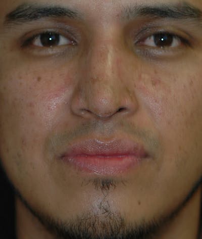 Rhinoplasty Before & After Gallery - Patient 400236 - Image 2