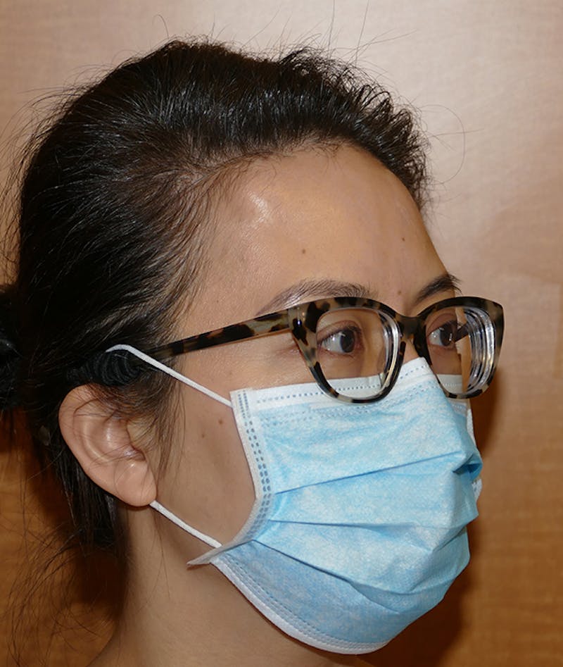 Miscellaneous Before & After Gallery - Patient 120526 - Image 5