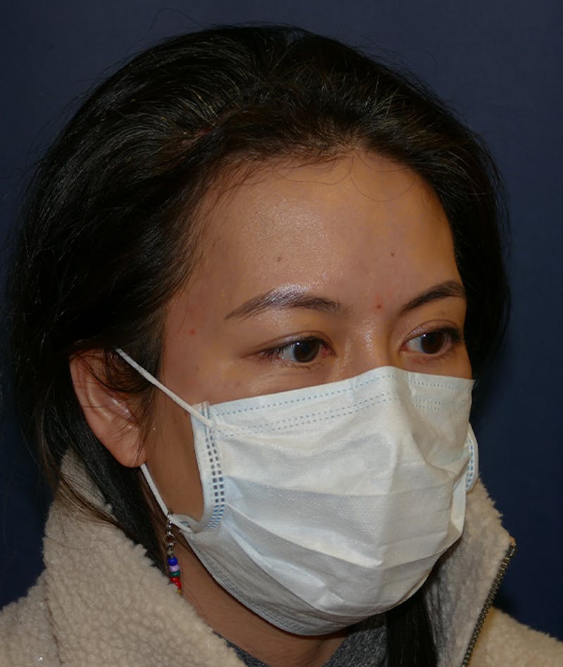 Miscellaneous Before & After Gallery - Patient 120526 - Image 6