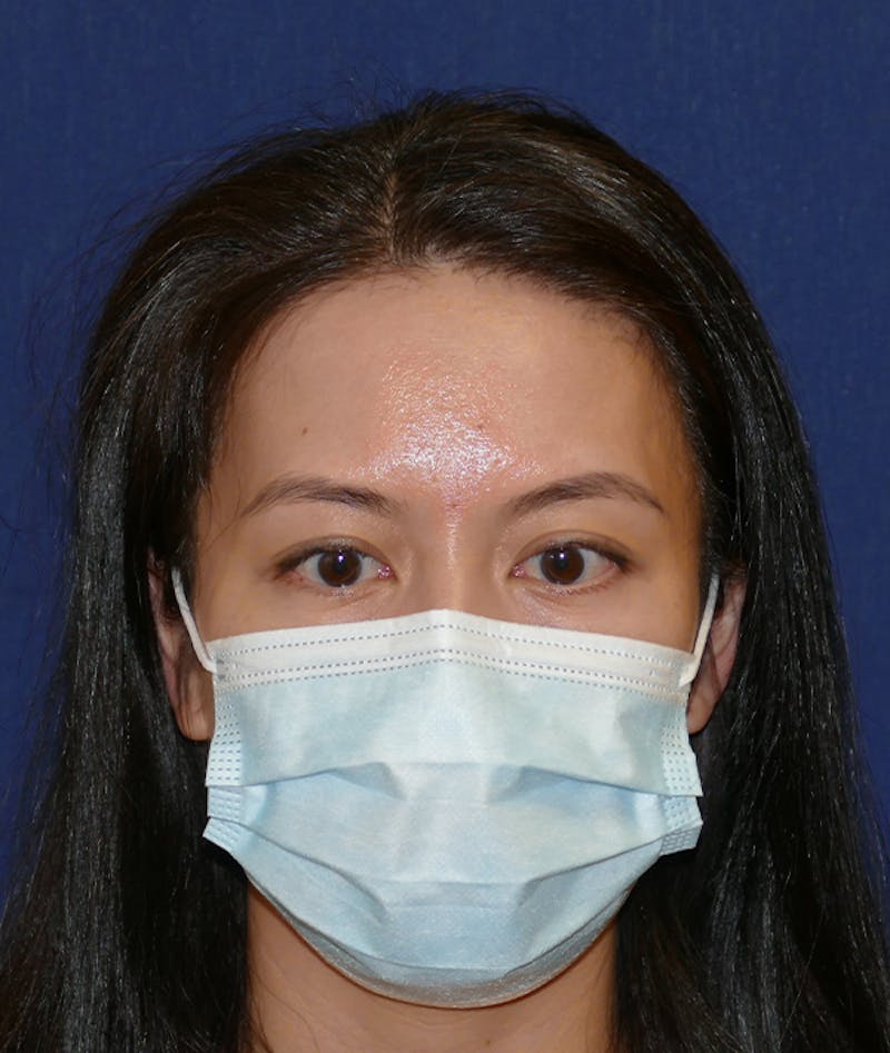 Miscellaneous Before & After Gallery - Patient 120526 - Image 4