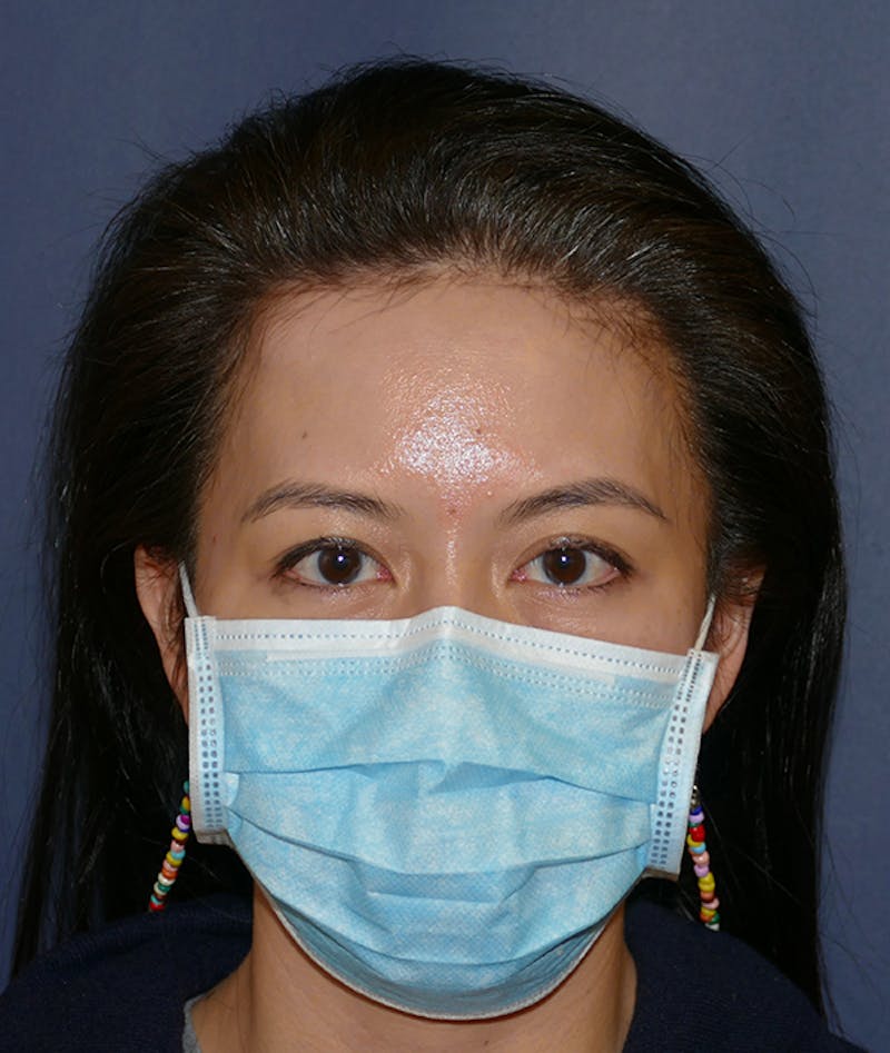 Miscellaneous Before & After Gallery - Patient 120526 - Image 3