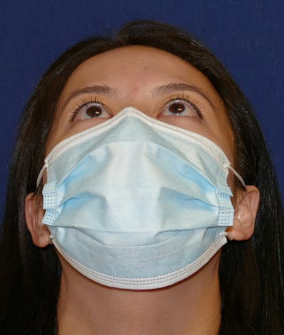 Miscellaneous Before & After Gallery - Patient 120526 - Image 2