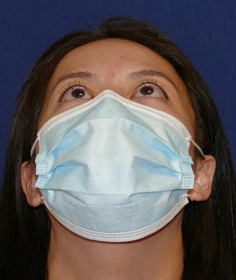 Miscellaneous Before & After Gallery - Patient 120526 - Image 2