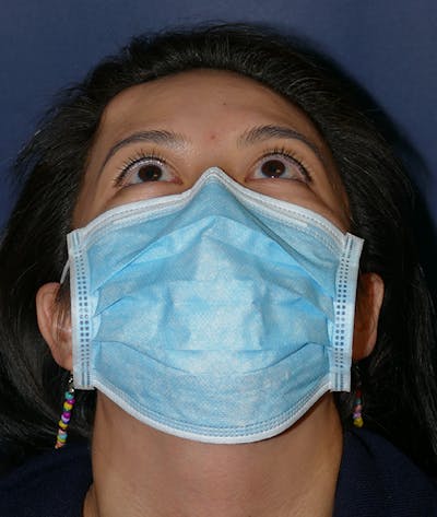 Miscellaneous Before & After Gallery - Patient 120526 - Image 1