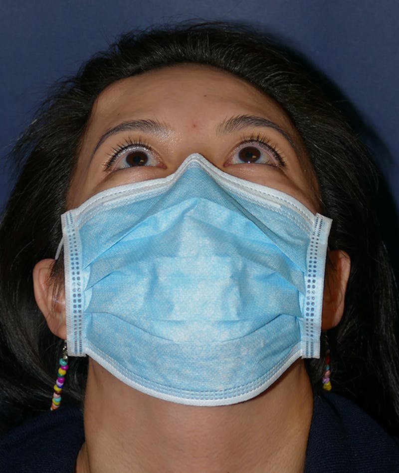 Miscellaneous Before & After Gallery - Patient 120526 - Image 1