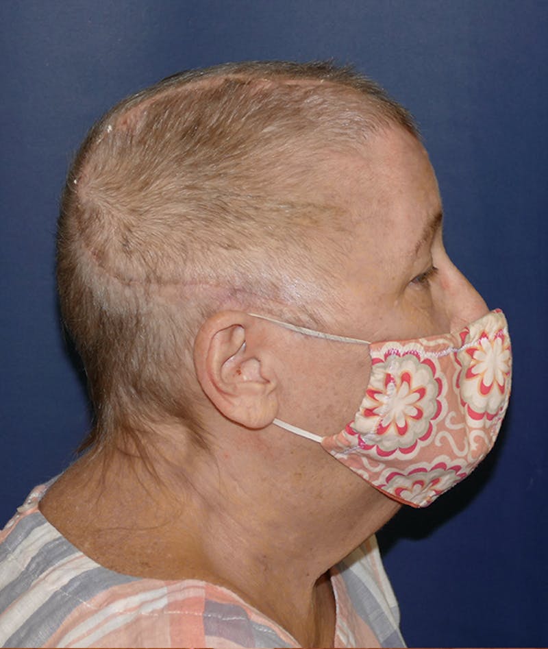 Miscellaneous Before & After Gallery - Patient 312897 - Image 5